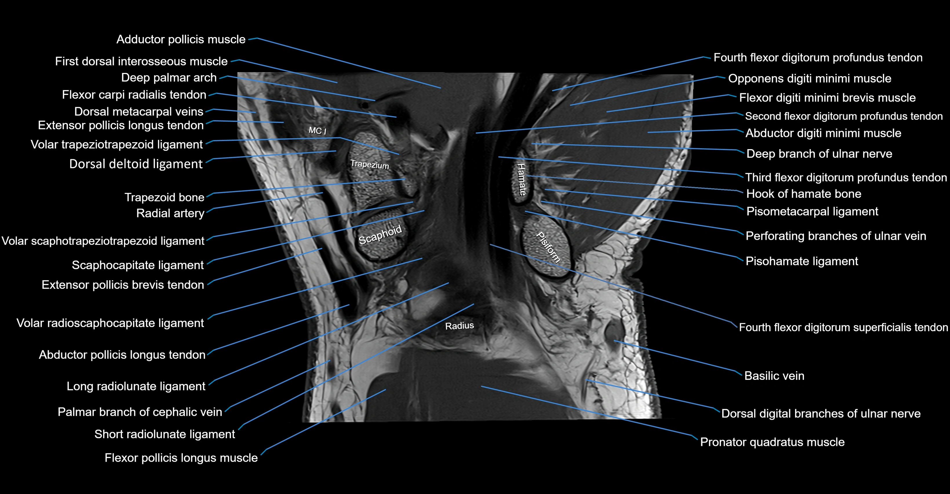MRI wrist coronal cross sectional anatomy 3T  radiology  image-img-00001-00017.webp